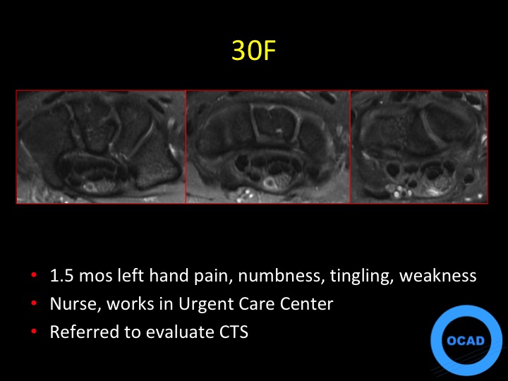 Figure 1 for case thrombus ( RID5037 )